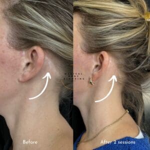 Before and after facelift scar camouflage tattoos