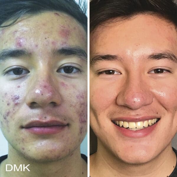 DMK Skincare Before After (1)