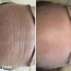 DMK Skincare Before After (10)