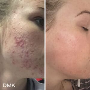 DMK Skincare Before After (11)