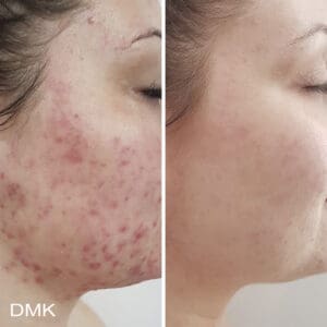 DMK Skincare Before After (12)