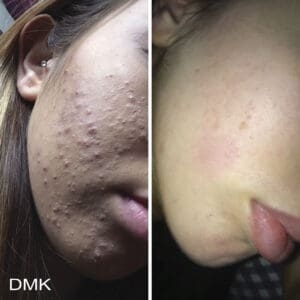 DMK Skincare Before After (2)