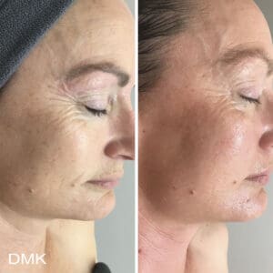 DMK Skincare Before After (3)