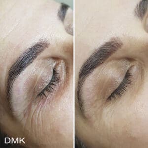 DMK Skincare Before After (4)