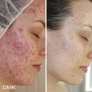 DMK Skincare Before After (5)