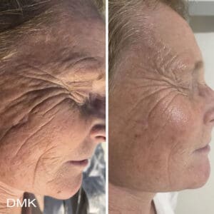 DMK Skincare Before After (6)