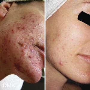 DMK Skincare Before After (7)