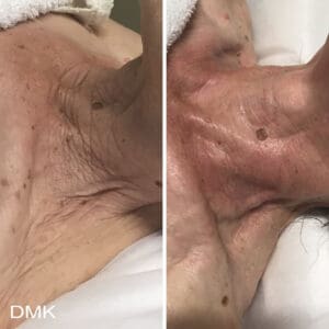 DMK Skincare Before After (8)
