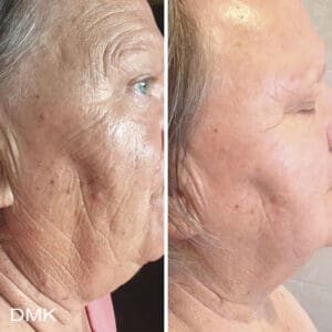 DMK Skincare Before After (9)