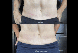 Stomach with before and after stretch mark tattooing camouflage
