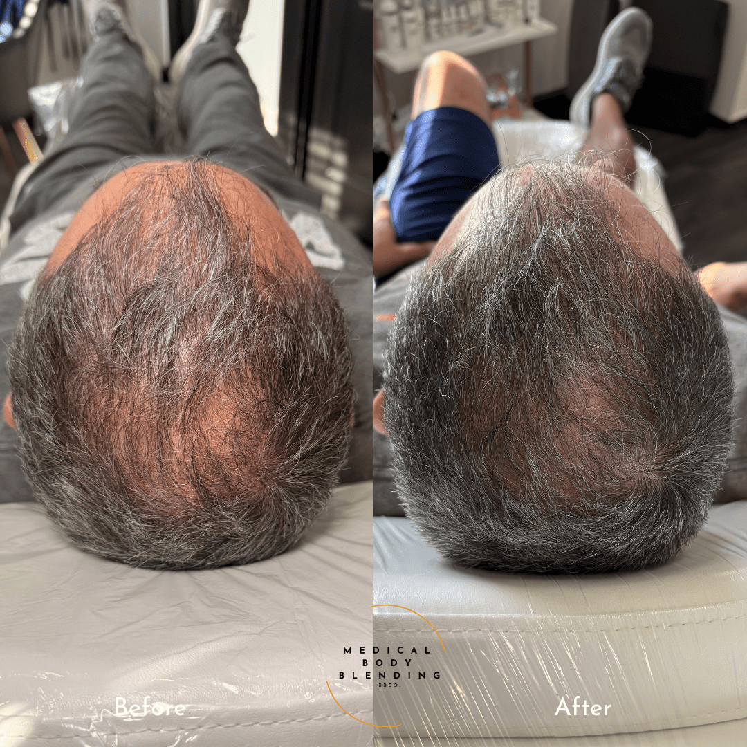 hair loss treatment 2